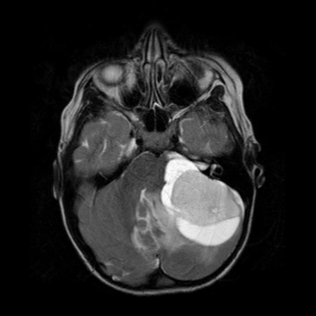 Diagnostic des Tumeurs Cerebral par l'IRM