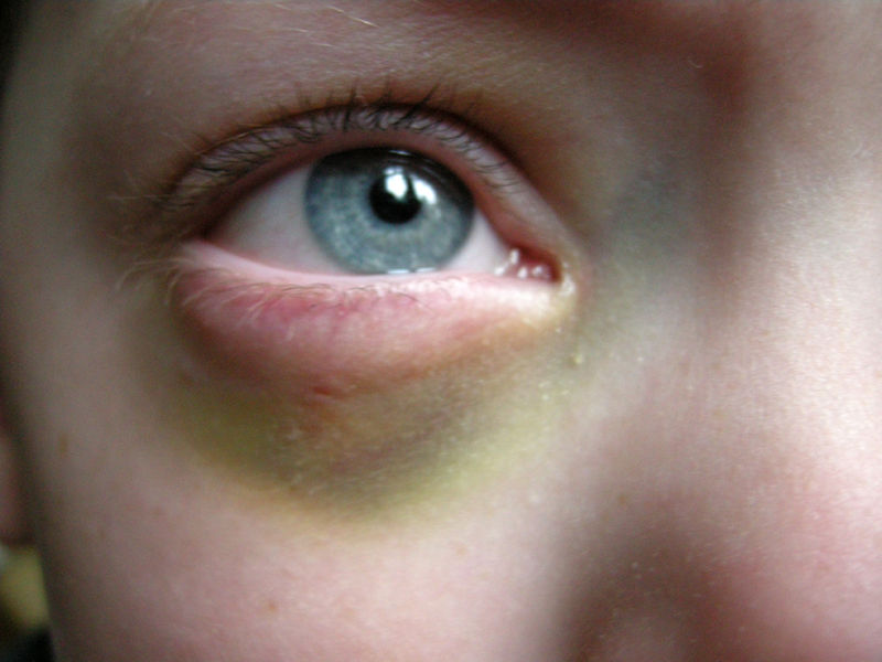 Oeil au beurre noir. Le blog de cat